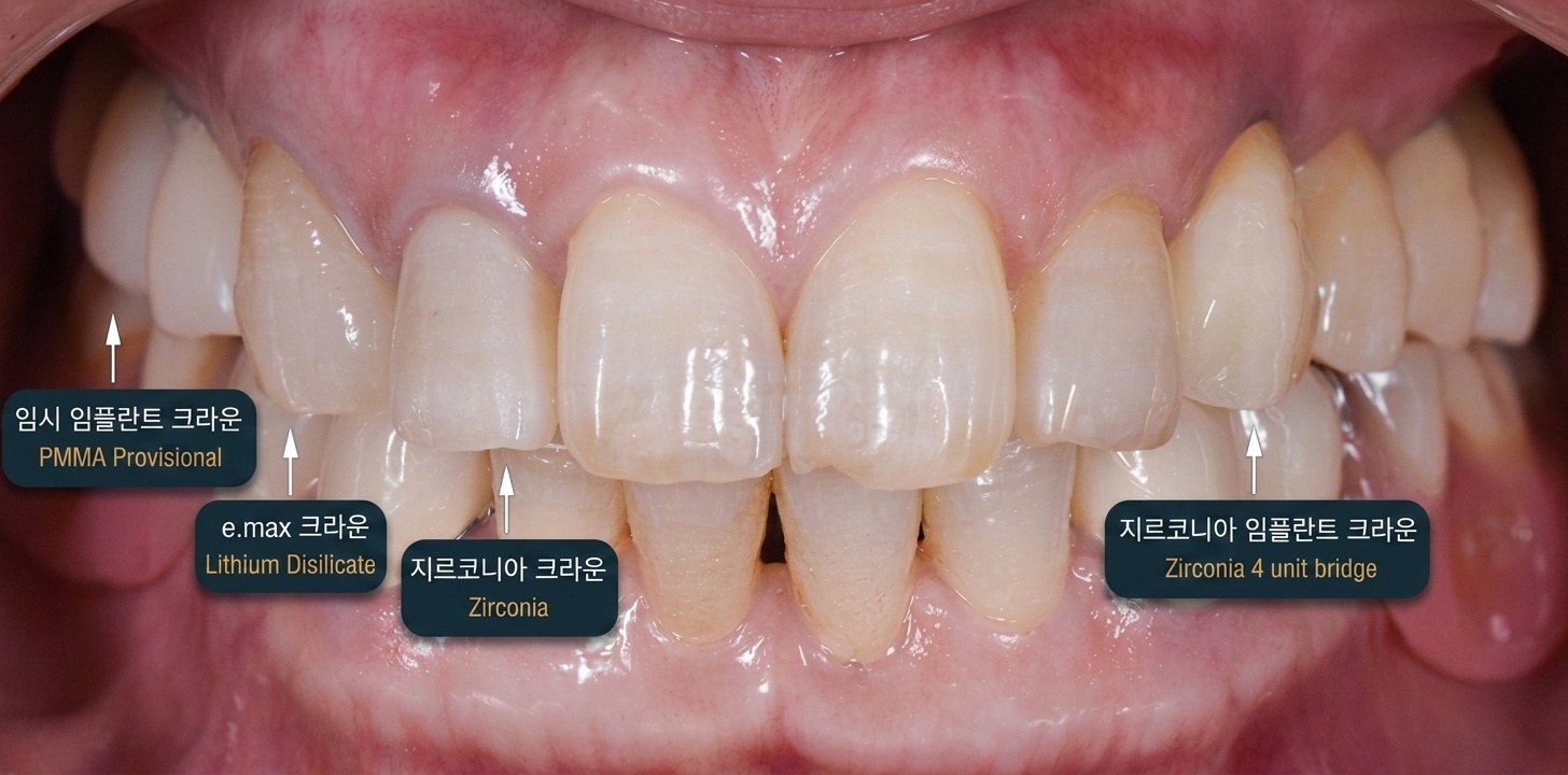 심미보철 재료별 케이스 — 임시 임플란트 크라운(PMMA), e.max(리튬디실리케이트), 지르코니아 크라운, 지르코니아 임플란트 브리지