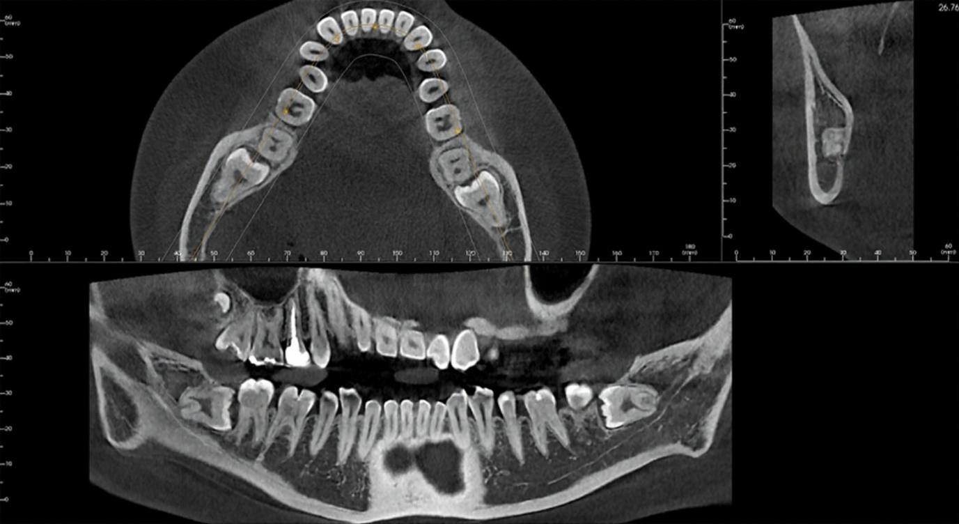 사랑니 3D CT 진단 (신경 위치 확인)