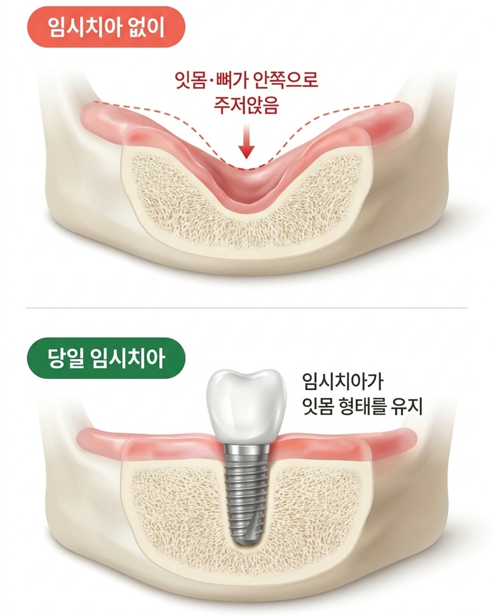 임시치아 유무에 따른 잇몸 형태 비교 — 임시치아 없이(잇몸·뼈 주저앉음) vs 당일 임시치아(잇몸 형태 유지)