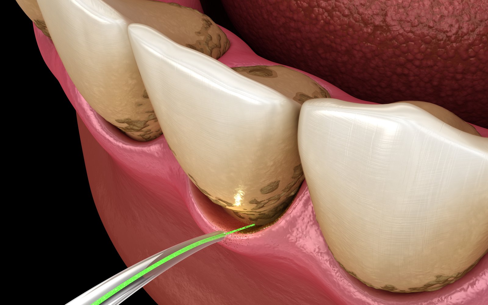 치주질환 진행 단계 (Periodontal Stages)