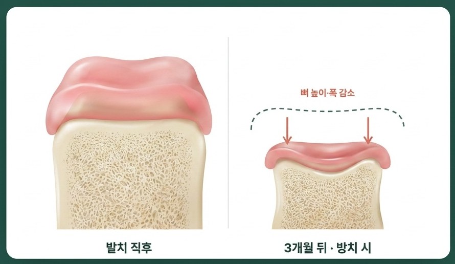 발치 후 잇몸뼈 흡수 비교 — 발치 직후 vs 3개월 뒤 방치 시